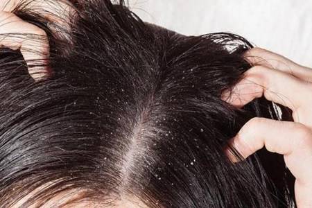 头皮屑多是什么原因引起的 女性头皮屑多还脱发怎么办